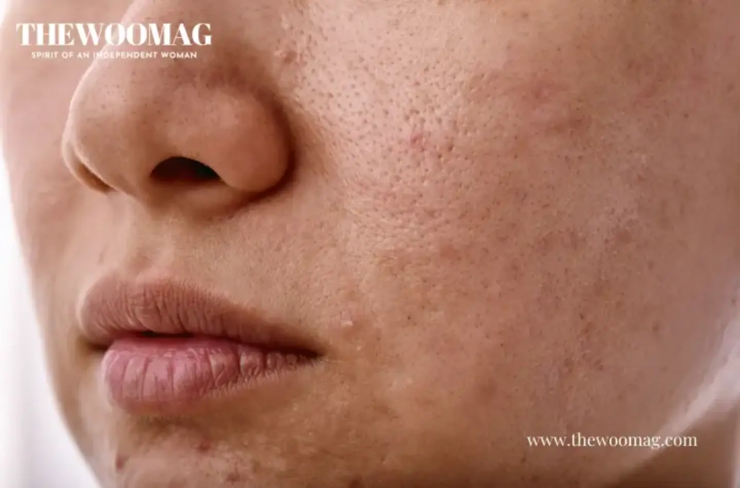 Get Rid Of Acne and Injury Scars with DIY Home Remedies